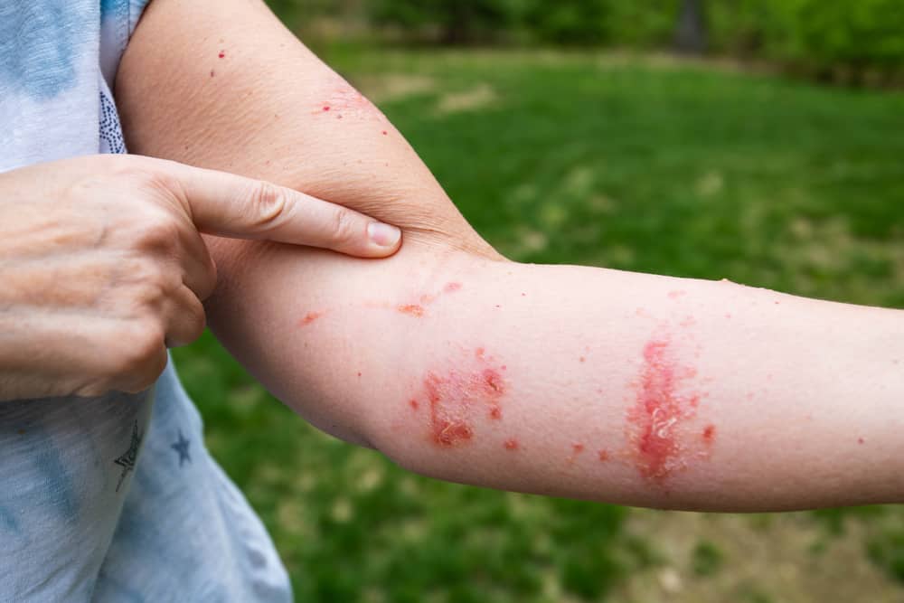Woman pointing at poison ivy rash on her arm.